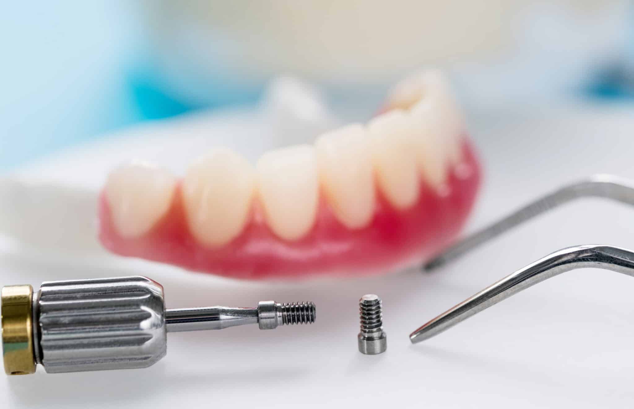 Getting to the root of the problem with dental implants