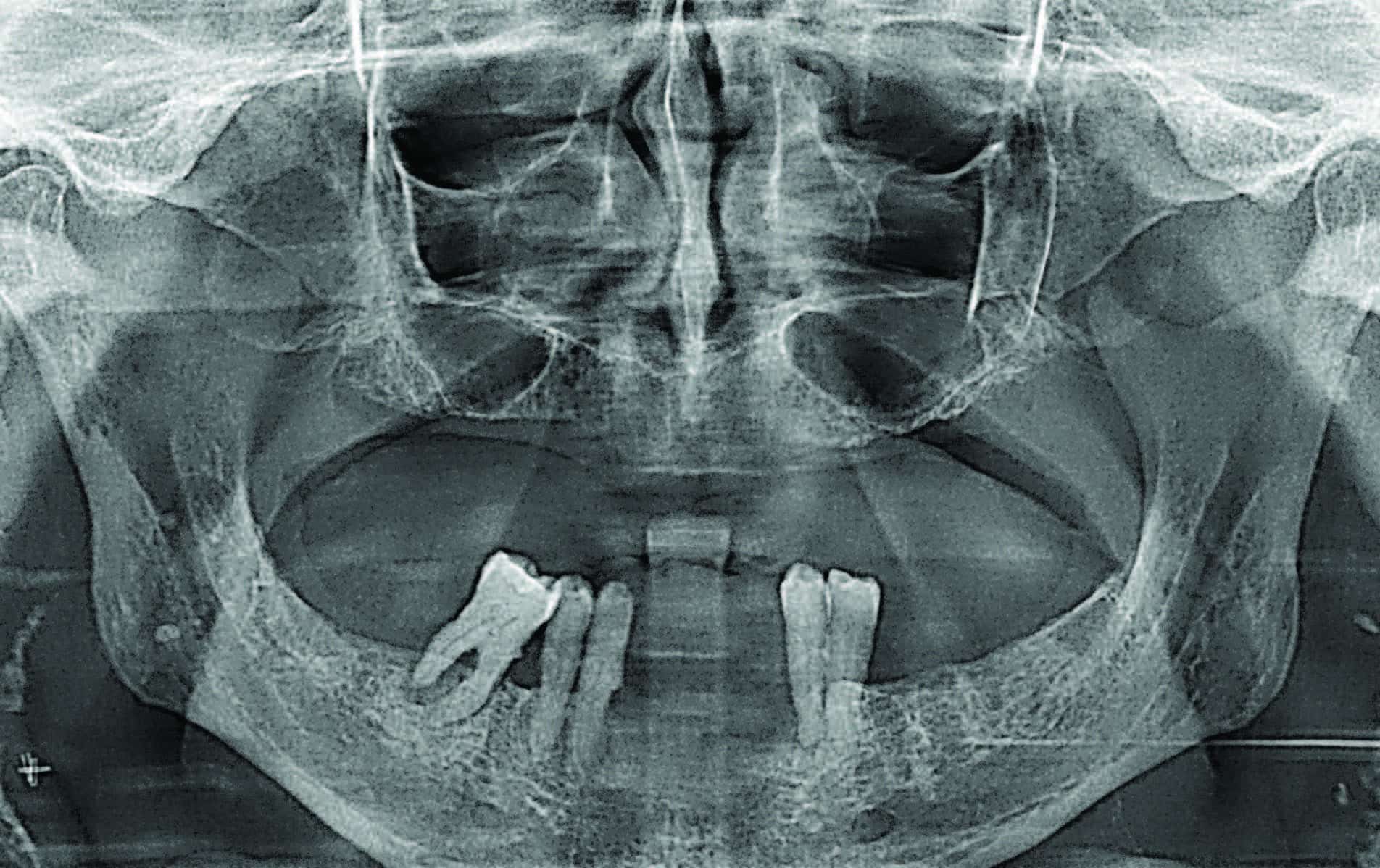 Carotid stenosis and the dental patient: An overview for the dental hygienist