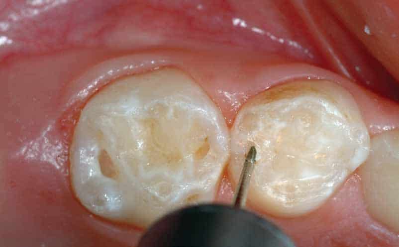Caries management: When, why, and how