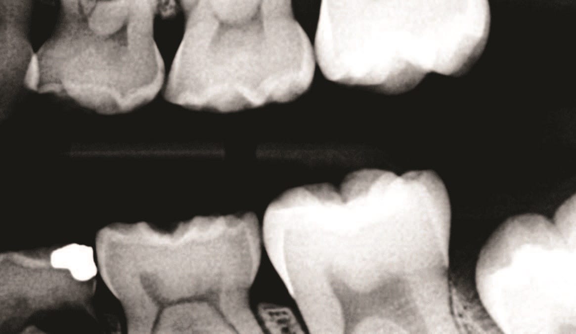 Caries management and minimal intervention dentistry: A collaborative approach
