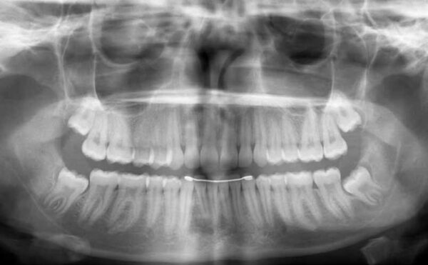 Management of Third Molars