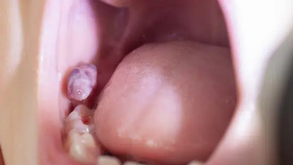soft-tissue lesions