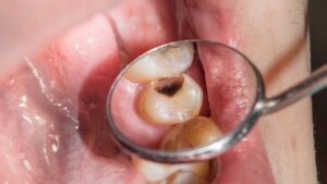Contemporary noninvasive dental caries treatment