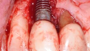 All screwed up: Strategic considerations for failing implants