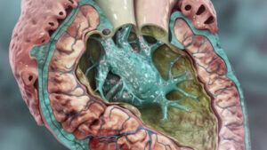 endocarditis
